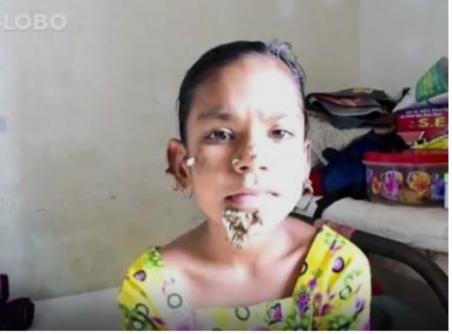 Menina de 10 anos pode ser primeira mulher com síndrome do 'homem-árvore'