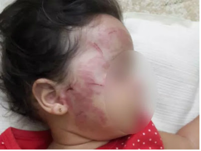 Bebê de 11 meses tem rosto desfigurado por criança de 2 anos em berçário de creche