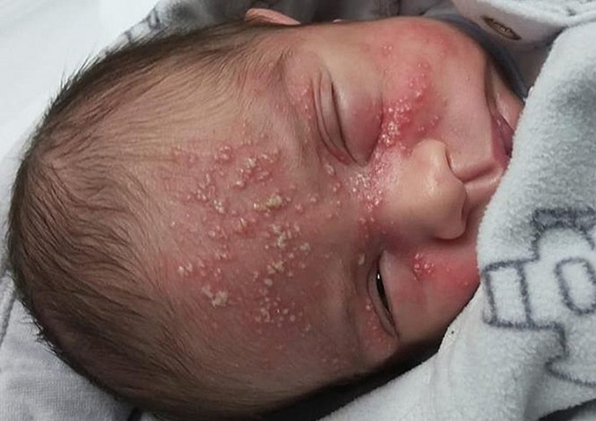 Baiana faz alerta após bebê ser infectado com herpes aos 17 dias