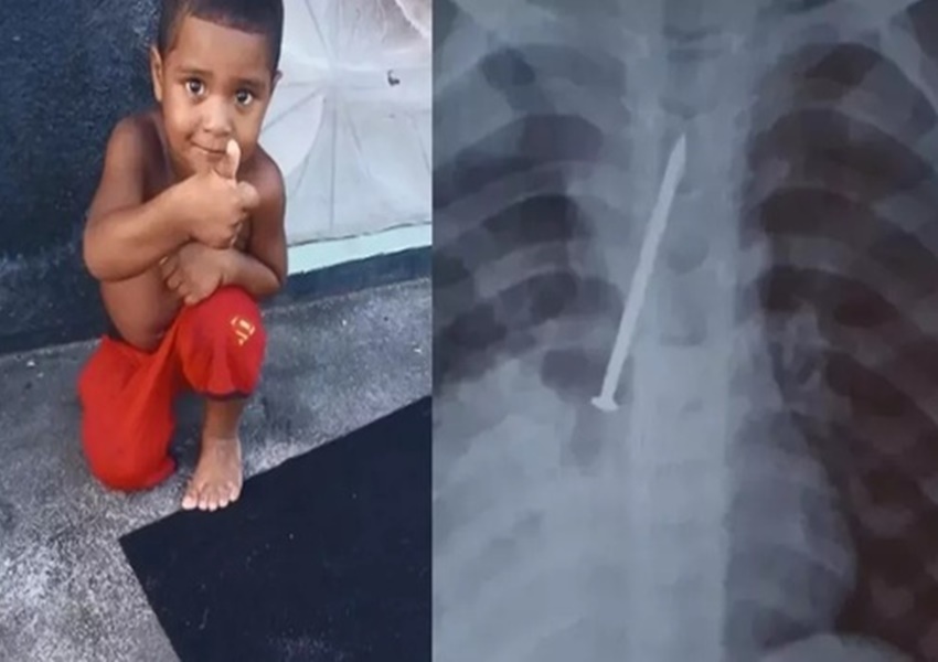 Canavieiras: Criança morre após passar 1 ano com prego no pulmão