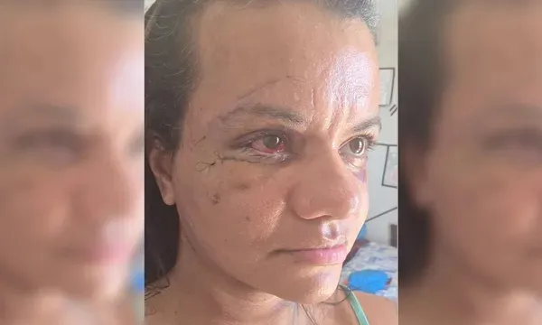 Mulher agredida com mais de 60 socos mostra rosto após cirurgia